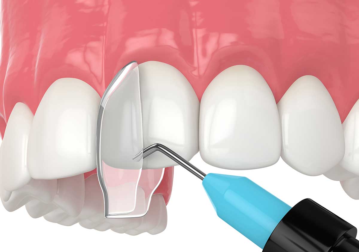 Composite Resin Bonding in Ormond Beach FL Area