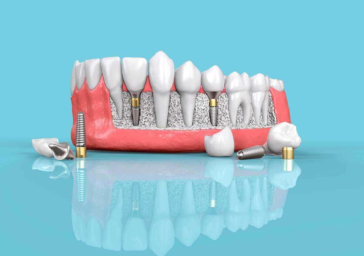 Discover the many advantages of dental implant restorations with the team at Cooper Dental Group