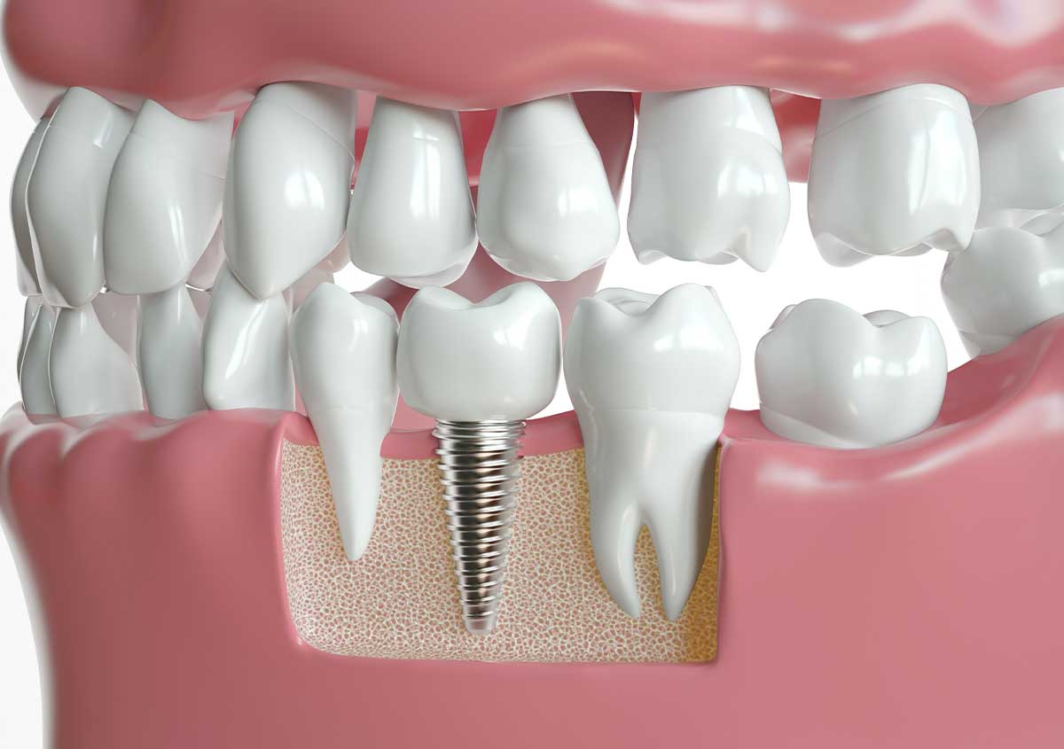 How Can I Maximize My Dental Implant Treatment?