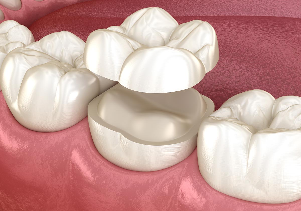 Repair Your Teeth and Restore Your Oral Health with Dental Crowns