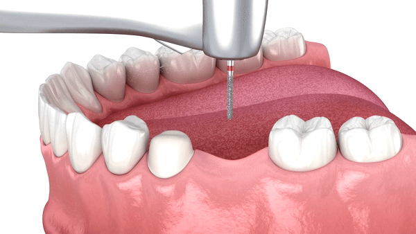 Dental Bridges placement Procedure explained