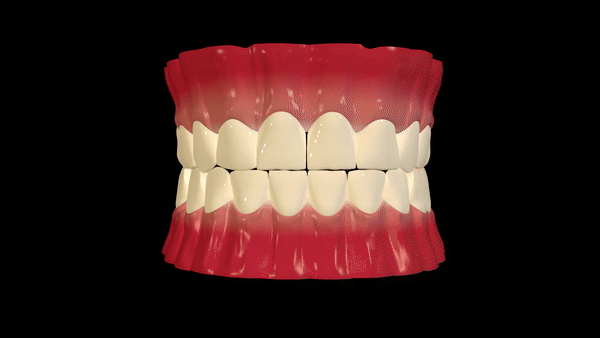 Dental Implants placement Procedure explained