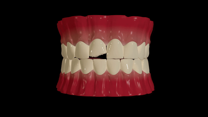 Dental Veneers placement