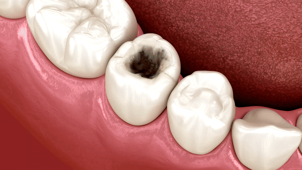Tooth colored fillings placement Procedure explained