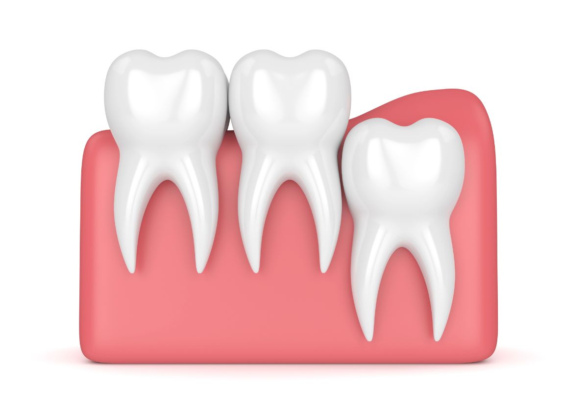Maintain a Painless, Healthy Life with Wisdom Teeth Extractions