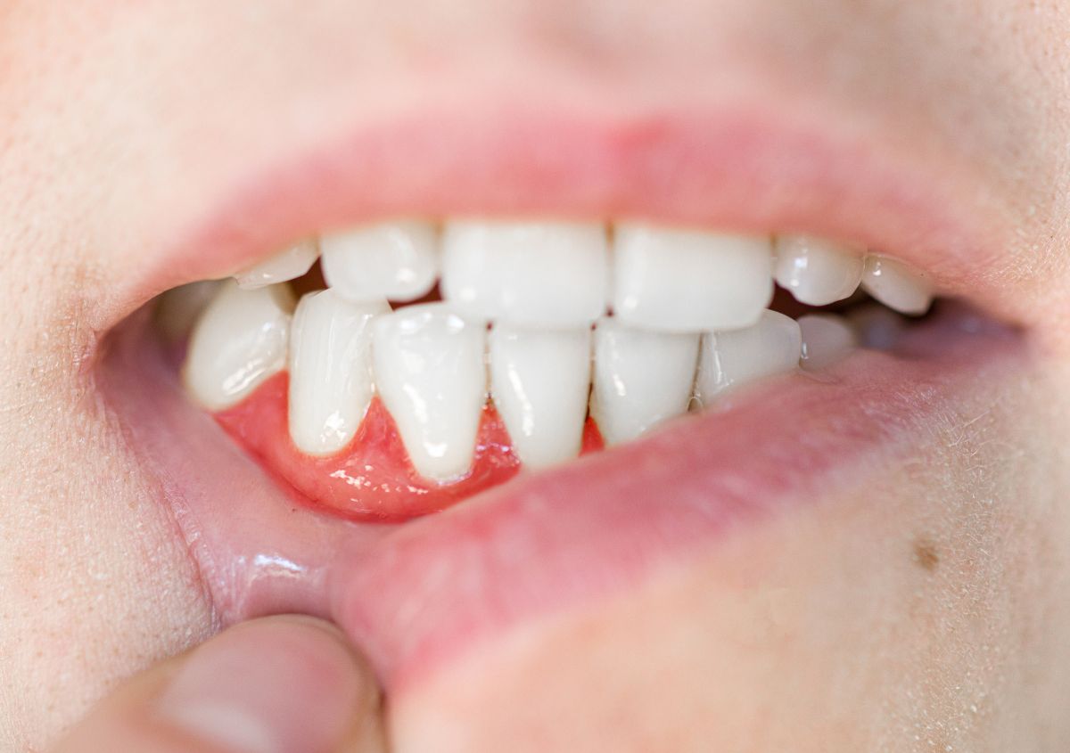 Keep Gum Disease at Bay with Periodontal Maintenance