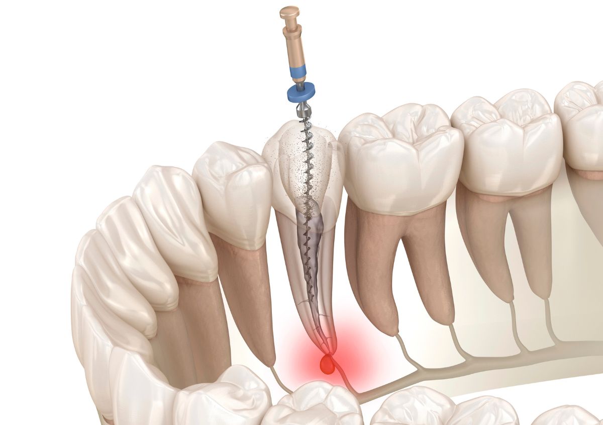 Root Canals & Pain: Separating Fact from Fiction in Ormond Beach, FL