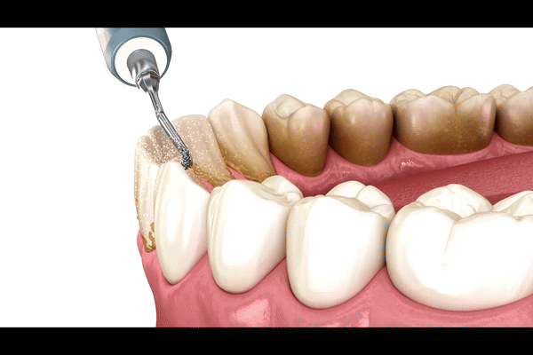 Dental Cleaning best dentist near me -Procedure explained animated video