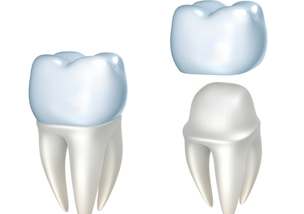 Quality Dental Crowns for Lasting Smiles